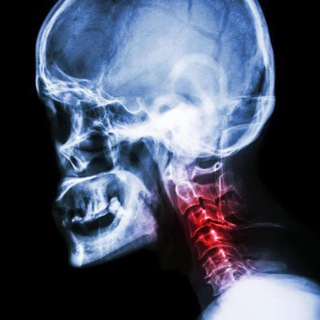 Шейный остеохондроз