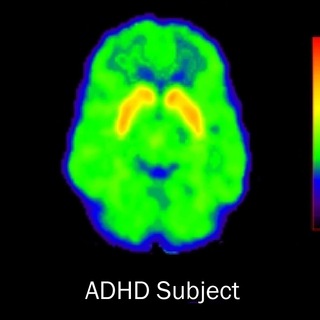 SDVG(ADHD), Blackpill, Science && Shitposting