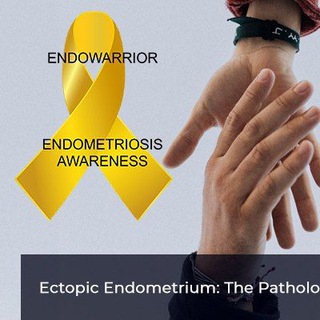 #Эндометриоз.поддержка